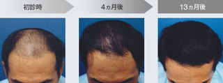 薄毛治療jpg.jpg